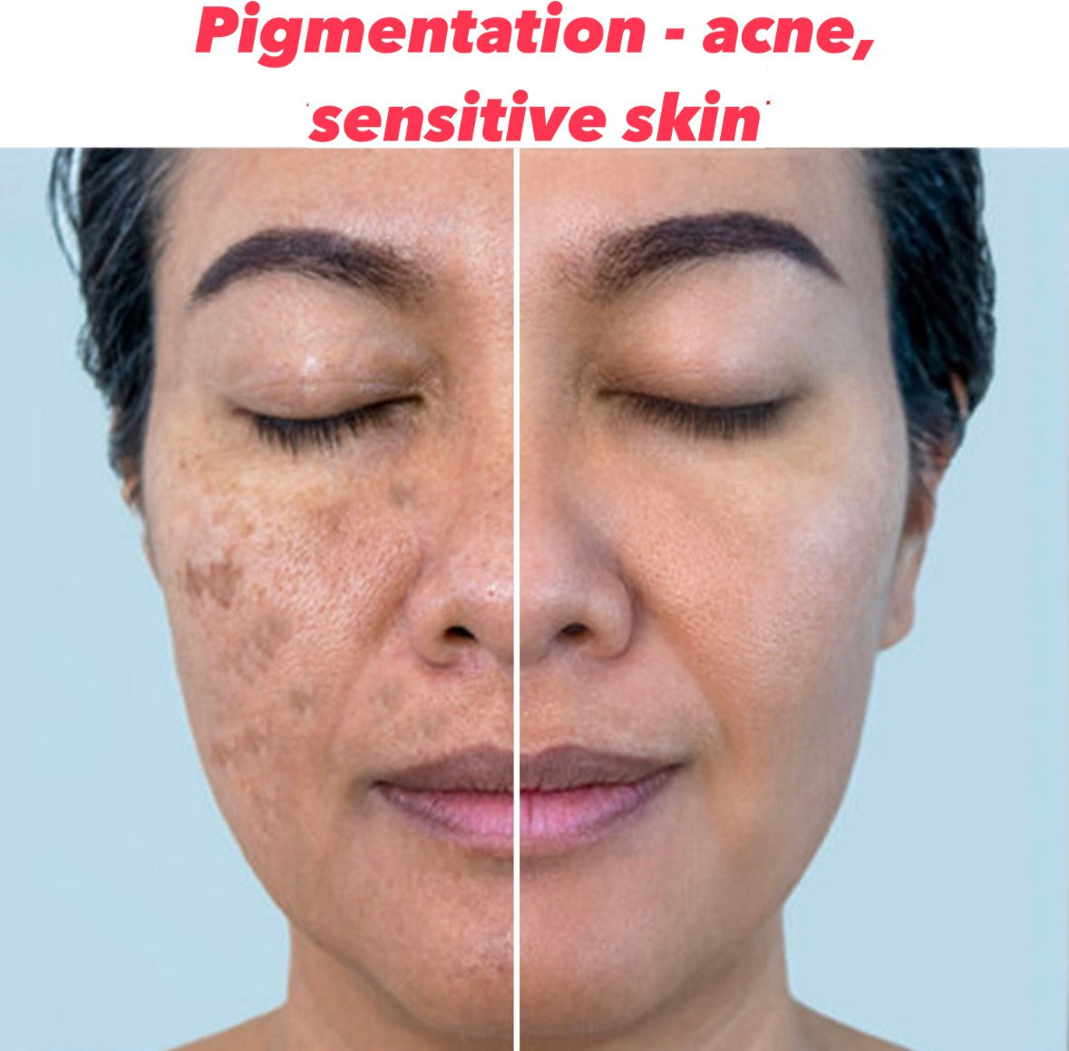 Pigmentation- Acne / sensitive skin