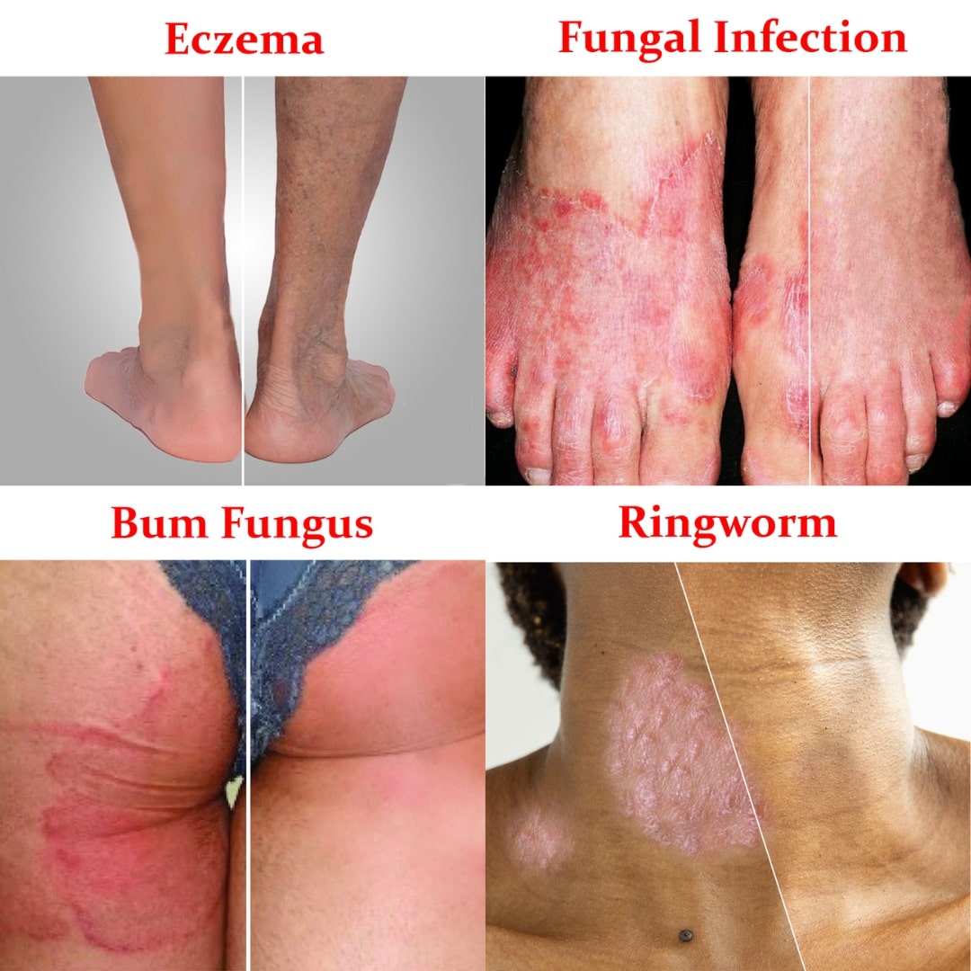 Eczema & Genetic Area