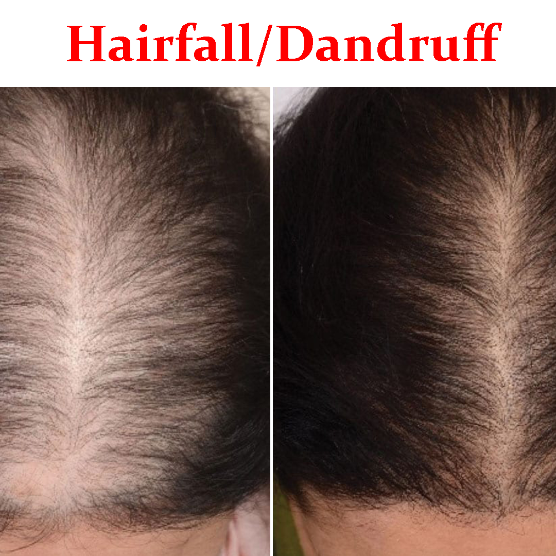 dandruff- Product Box