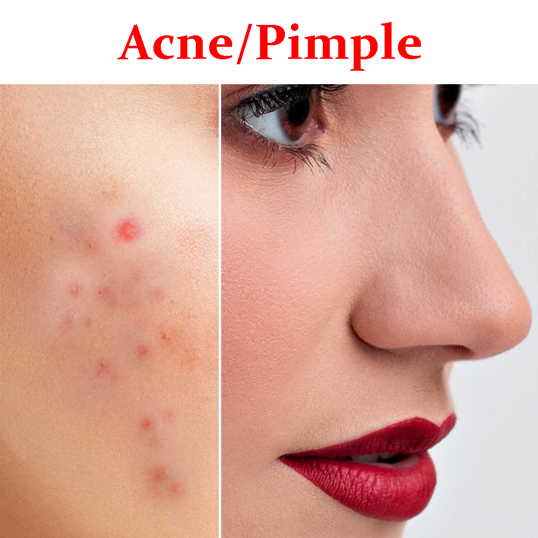 Pimples & Acne Product Box