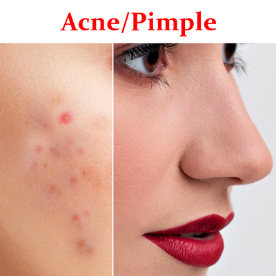 Acne/Pimple