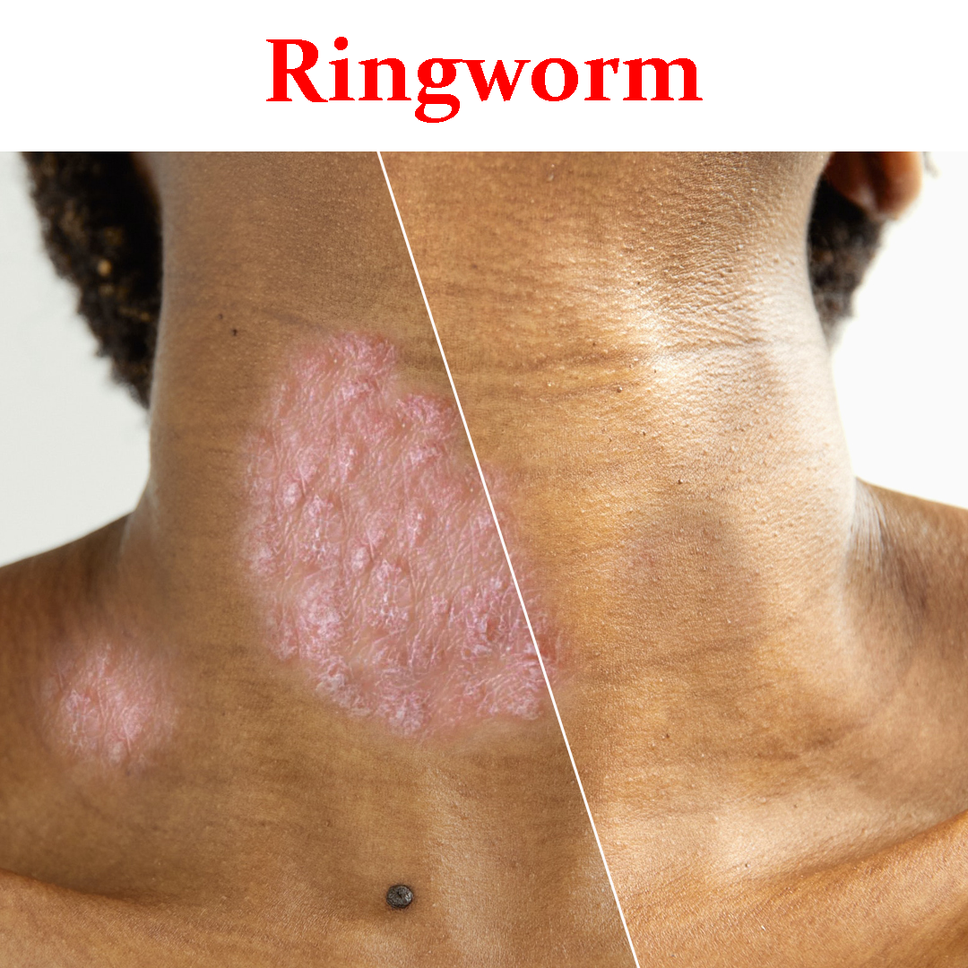 Ringworms- Product Box